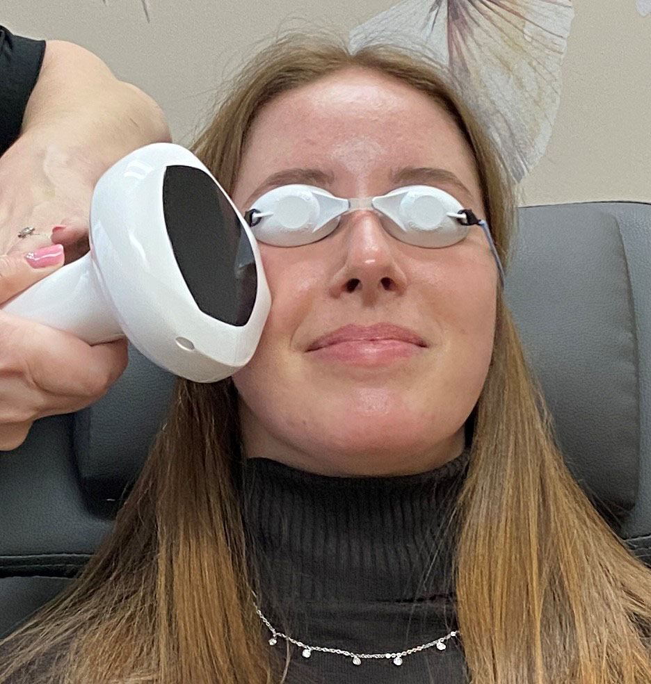 Woman with ocular rosacea receiving Lumecca IPL – dry eye treatment for Meibomian – gland disease